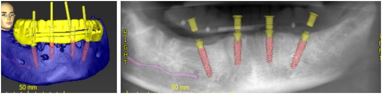 CBCT Scans And Digital Implant2