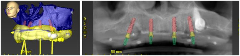CBCT Scans And Digital Implant