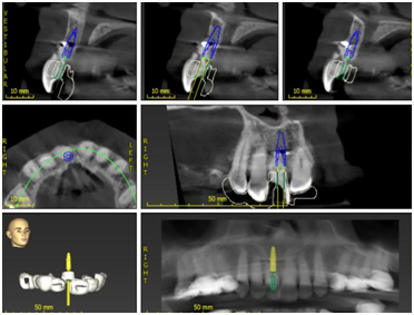 Implant Placement Surgery